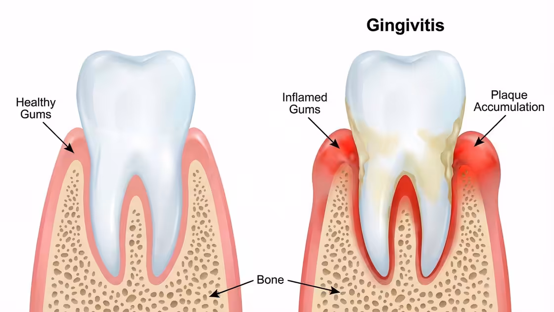 Periodontal Gingivitis