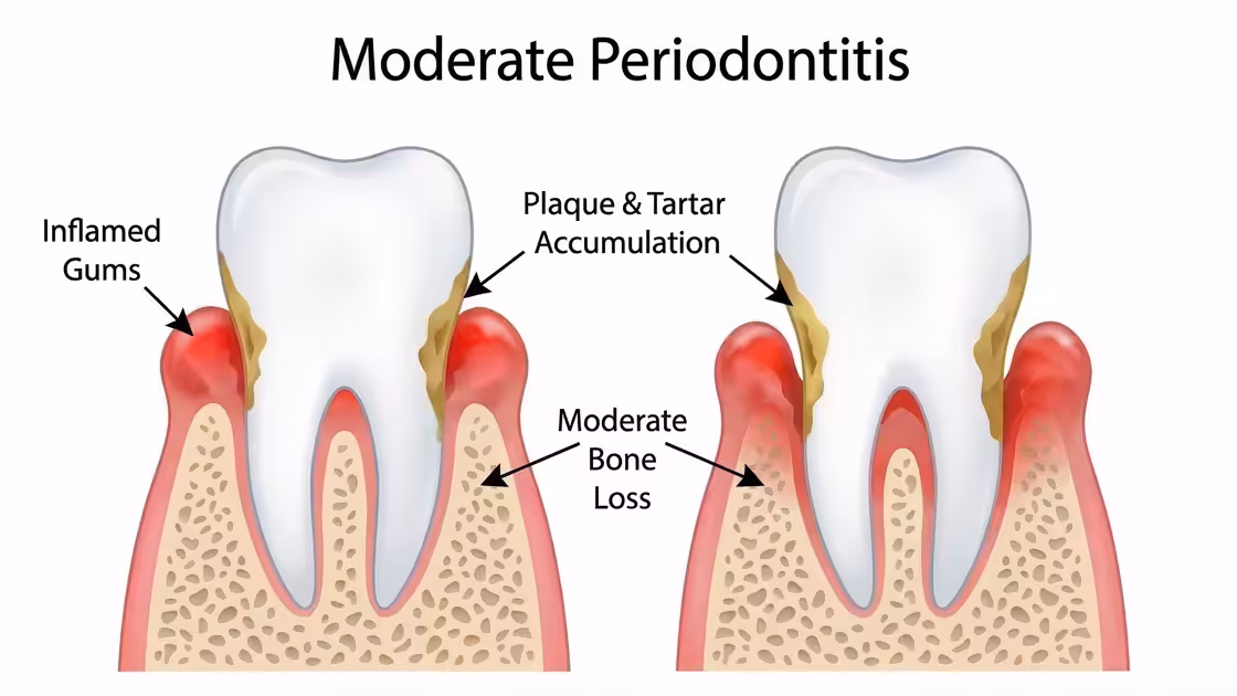 Moderate Periodontitis
