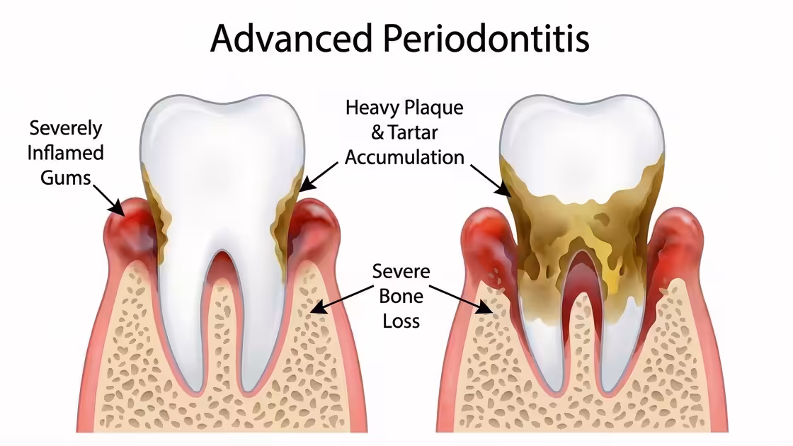 Advanced Periodontitis