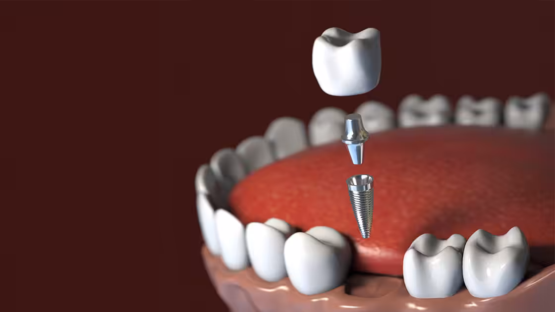 Dental implant graphic