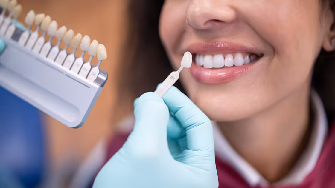 Dental veneers dr with shade guide