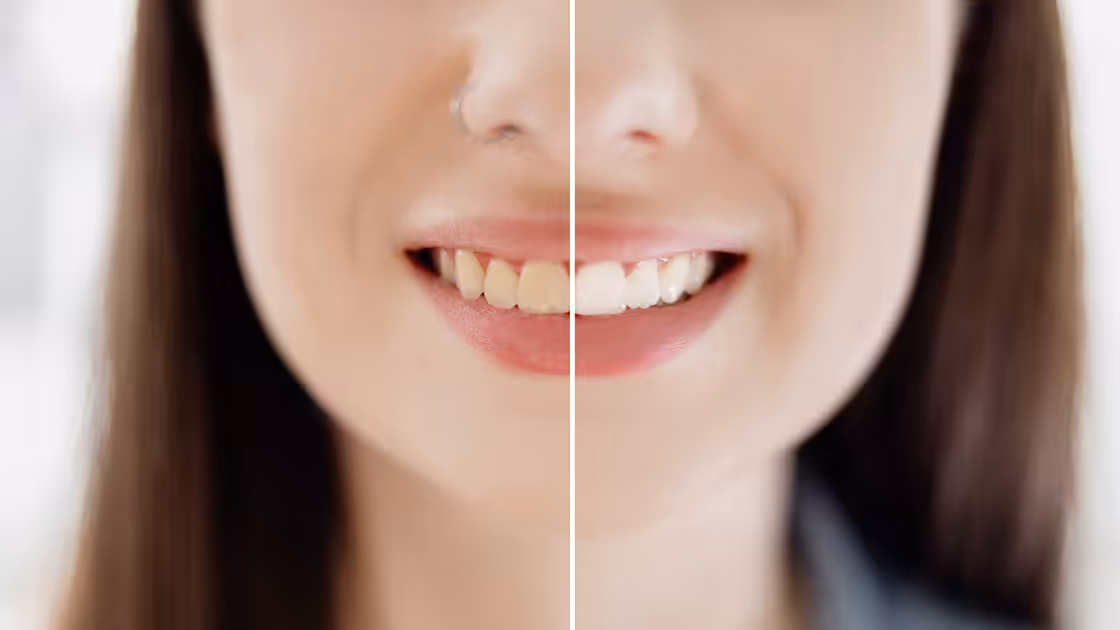 Tooth whitening patient before and after