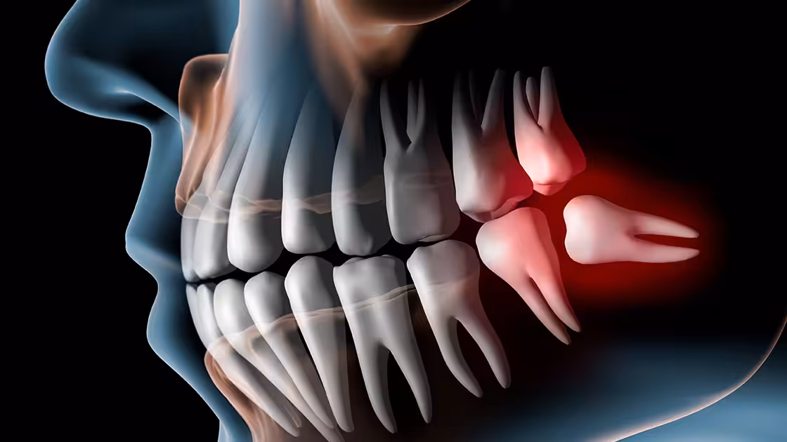Wisdom teeth impacted graphic